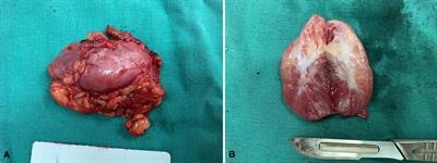 Management of Vulvovaginal Cellular Angiofibroma: A Single-Center Experience